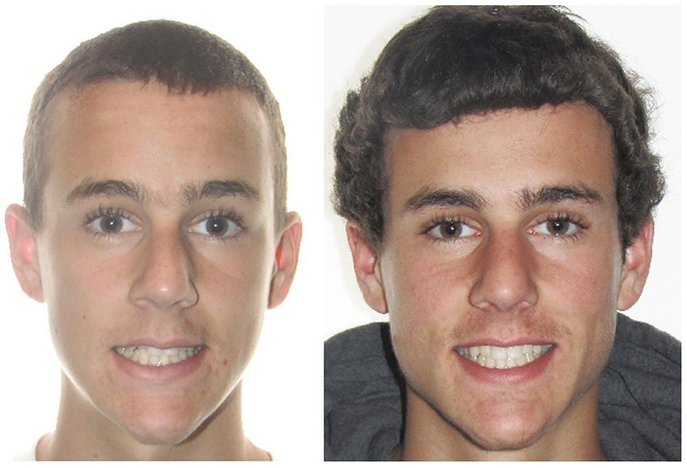 Norwalk Dental Care | Inlays  amp  Onlays, Carillas and Sonrisa Saludable, Cuerpo Saludable